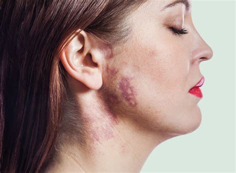 Birthmark Removal Dorset Laser Skin Solutions