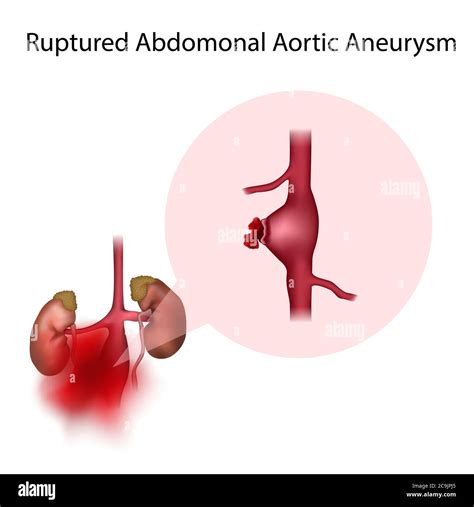 Abdominal Aortic Aneurysm Hi Res Stock Photography And Images Alamy