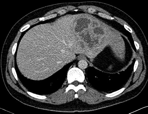 Pyogenic Liver Abscess Frontline Gastroenterology