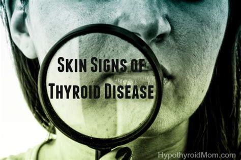 Skin Signs Of Thyroid Disease Hypothyroid Mom