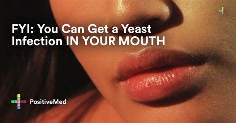 Can You Get A Yeast Infection In Your Mouth Positivemed