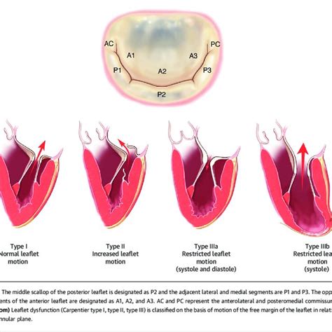 Mitral Valve Anatomy And Carpentier Classification Of Mitral