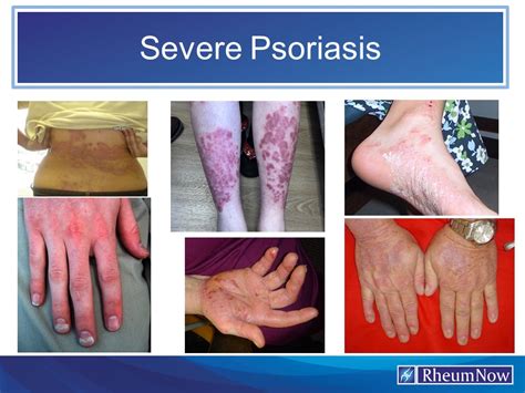 Severe Psoriasis Rheumnow