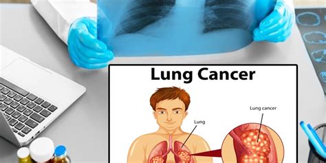 Diagnosing Lung Cancer At An Early Stage Can Save Lives Know About 4
