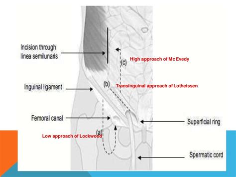 Femoral Hernia