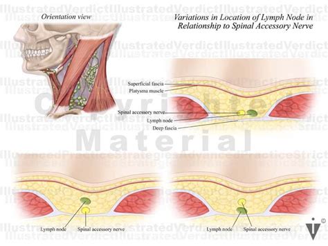 Stock Neck Lymph Node Biopsy — Illustrated Verdict