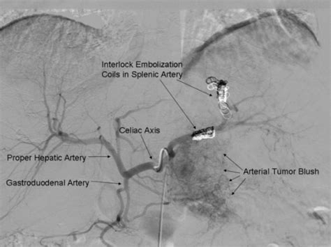 Figure 3multi Visceral Resection Of Pancreatic Vipoma In A Patient