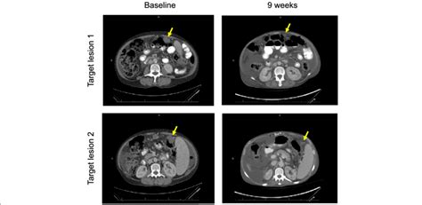 Baseline Images Left Compared With 9 Week Ct Scan Right Showing