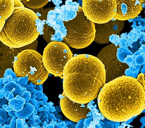 Staphylococcus Aureus In Patients Diagnosed With Bronchiectasis Without