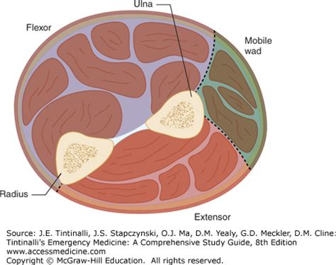 Webmd explains compartment syndrome, a potentially life threatening condition in which pressure builds up in the legs, abdomen or arms, damaging tissue. Compartment Syndrome | Anesthesia Key