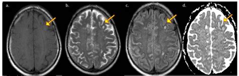 A 66 Year Old Male Patient Diagnosed With Cryptococcal Meningitis And