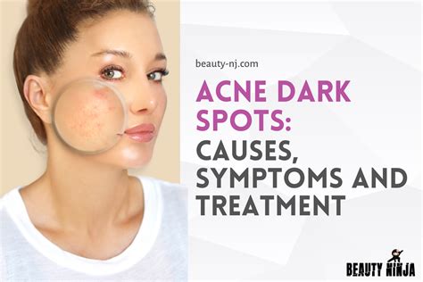 Acne Dark Spots Causes Symptoms And Treatment Beauty Ninja