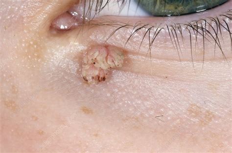 Wart On Eyelid Stock Image C0017393 Science Photo Library