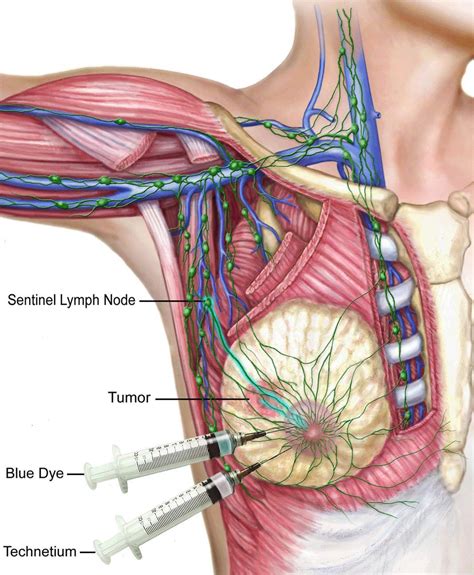 For example, if breast cancer spreads to your lungs, that doesn't mean you have lung cancer. Sentinel Lymph Node - Biopsy, Location, Melanoma, Breast ...