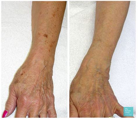 Laser For Deep Wrinkles Cosmetic Surgery Tips