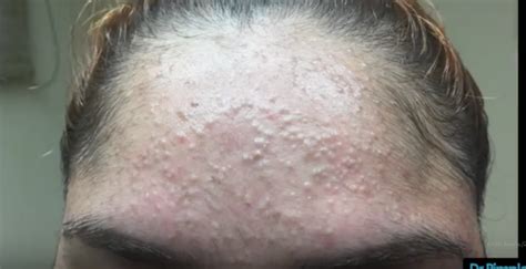 Watch What Comes Out When Dr Pimple Popper Squeezes This Forehead Full Of Zits [video] John