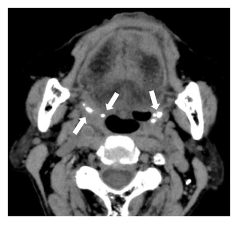 Axial Ct Images A Single Large Tonsillolith In The Left Palatine