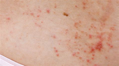 The Best 10 Small Red Itchy Bumps On Skin Treatment Tostessy