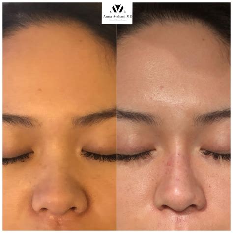 Mindfulness Permanent Non Surgical Nose Job Philippines 2022 My Reff