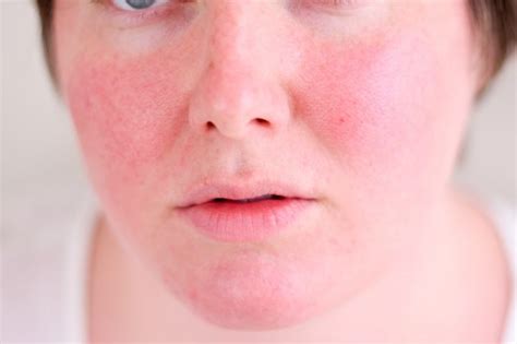 Skin Discoloration Causes Types Picture And Treatment