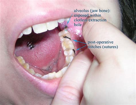 Dry Socket After Wisdom Tooth Extraction Ear Nose Throat And Dental Problems Articles