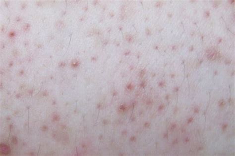 Keratosis Pilaris Chicken Skin Causes Pictures And Treatment