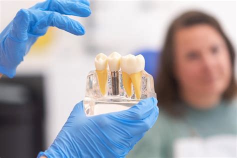 ¿cuántos Tipos De Implantes Dentales Existen Implantes Dentales