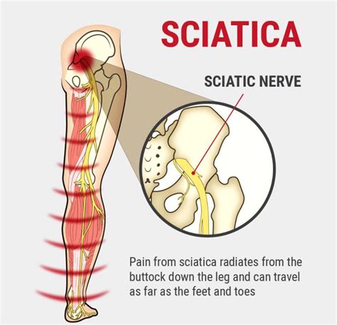 Sciatic Nerve Injury EP Wellness Functional Medicine Clinic