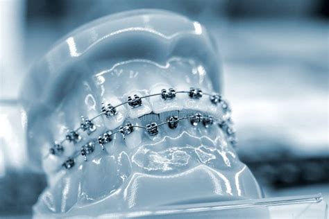 Braces On Artificial Teeth Close Up Dental Tooth Dentistry Stock
