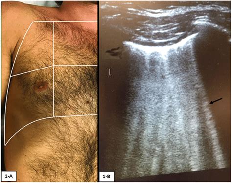 A Lung Zones In Chest Ultrasound With Permission From Credit A Tozer