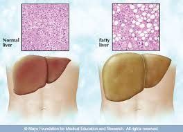Fatty Liver | Fatty liver, Fatty liver disease, Liver disease