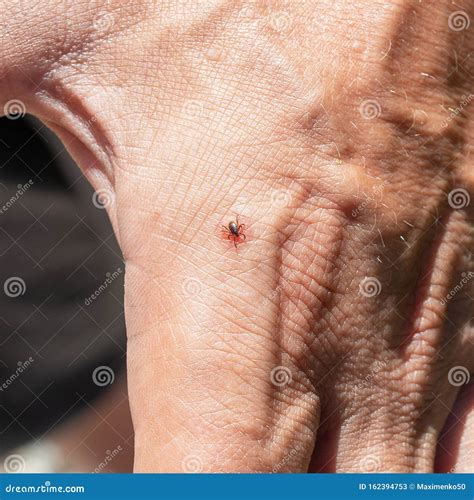 Tick Bit Human Hand Ixodes Ricinus Parasitic Mite Acarus Dangerous