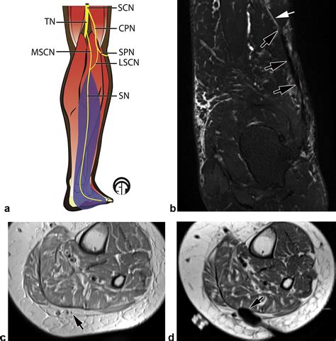Mr Imaging Guided Cryoneurolysis Of The Sural Nerve Journal Of