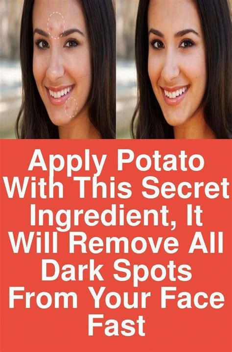 Ways To Eliminate Dim Spots From Facial Area Within Just 2 Days