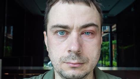 Portrait Of Man With Swollen Eye Suffers From Conjunctivitis Stock