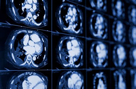 Low Dose Ct Scan For Lung Cancer Screening