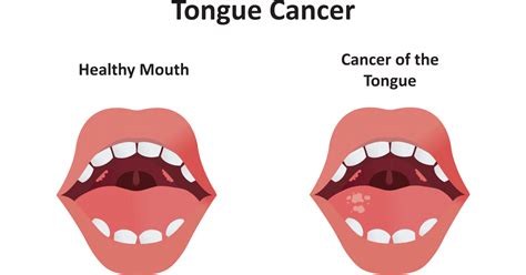 tongue cancer symptoms stages causes prevention and treatment