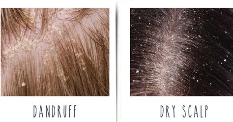 Dandruff Vs Dry Scalp The Difference Causes Prevention And Treatment