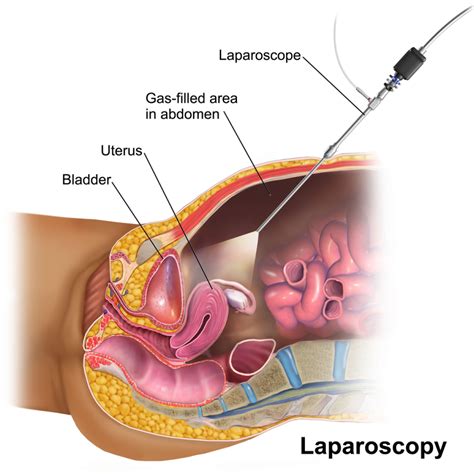 Laparoscopy Overview Dr Anastasios Christodoulou