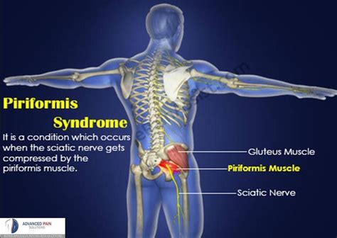 Piriformis Syndrome Piriformis Syndrome Sciatica Treatment Piriformis Muscle