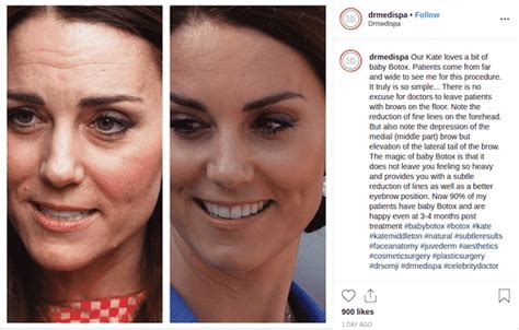 Kate Middleton Adepte Du Botox Un Chirurgien D Voile Un Avant Apr S
