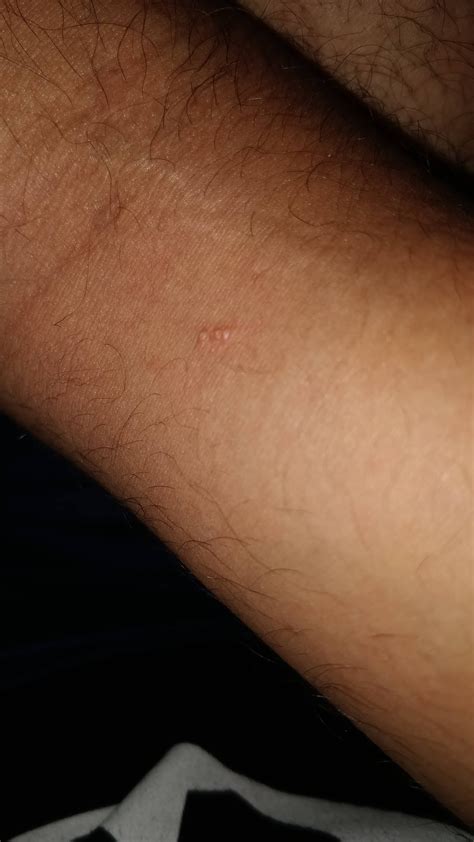 These Weird 3 Bumps Showed Up On My Arm They Dont Itch Or Burn Or