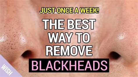 Ultimate Blackhead Removal And Preventing Tips How To Remove Blackheads