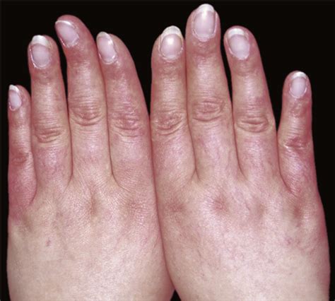 Hand Edema And Acrocyanosis “puffy Hand Syndrome” Dermatology Jama
