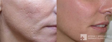 Conditions And Treatments Acne Scars And Their Treatment Sydney