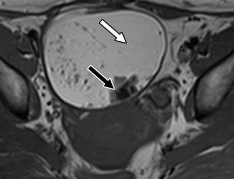Multimodality Imaging Approach To Ovarian Neoplasms With Pathologic