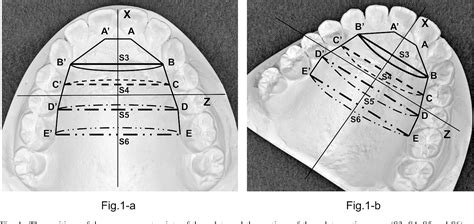 Figure 1 From Three Dimensional Measurements Of The Palate Using The