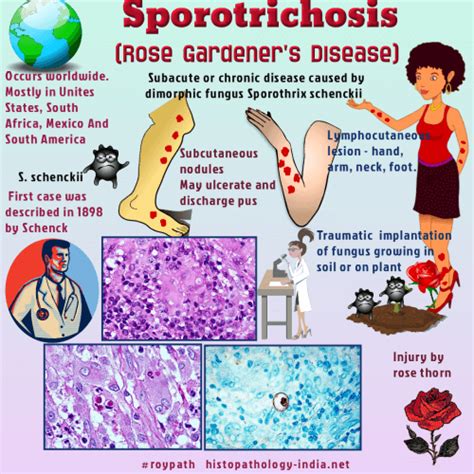Pathology Of Sporotrichosis Dr Sampurna Roy Md