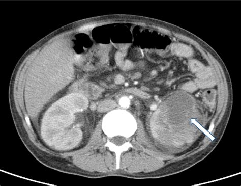 Cureus Renal Abscess And Recurrent Bacteremia Caused By Campylobacter