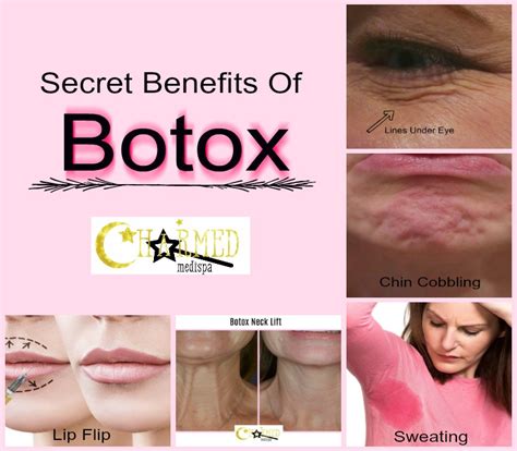 Secret Benefits Of Botox Charmed Medispa